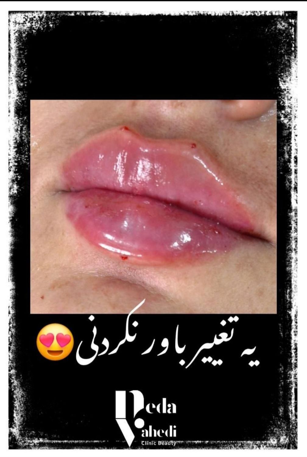 آموزش ژل بوتاکس سابسیژن مزوتراپی مزونیدل فیلربادی|خدمات آموزشی|کرج, مهرویلا جنوبی|دیوار