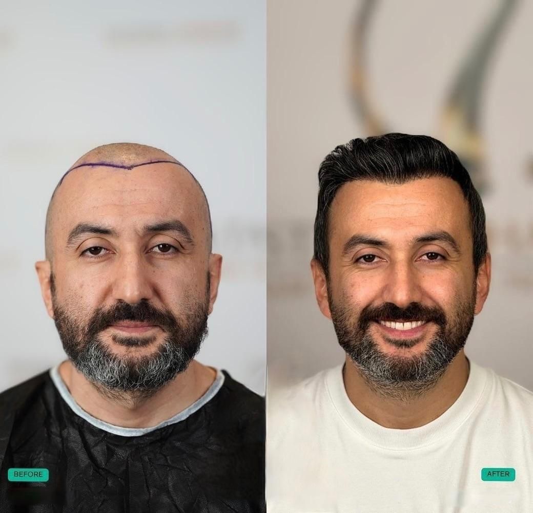 کاشت مو و ابرو و ریش بدون جراحی تراکم بالا|خدمات آرایشگری و زیبایی|تهران, الهیه|دیوار