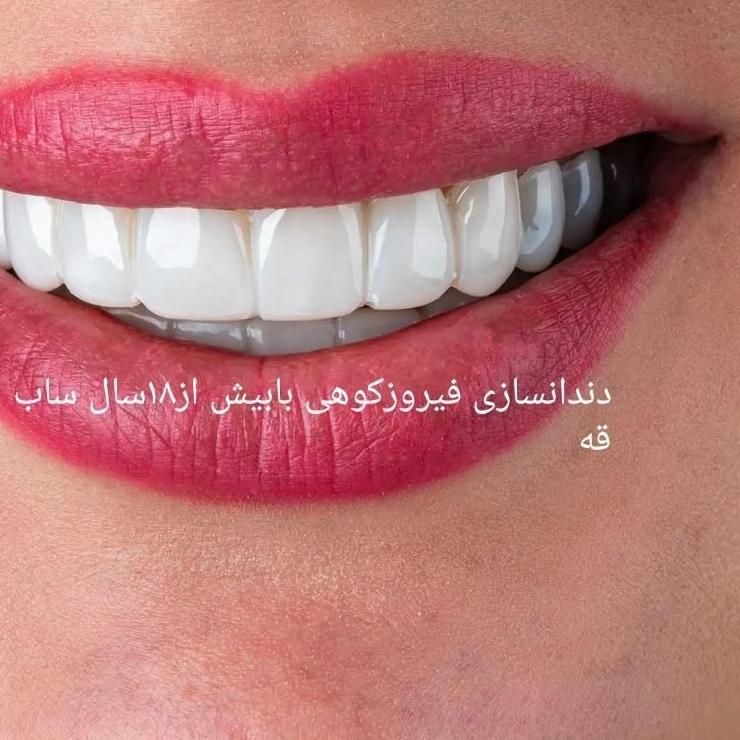 ساخت دندان مصنوعی تحویل یک روزژله|خدمات آرایشگری و زیبایی|زابل, |دیوار