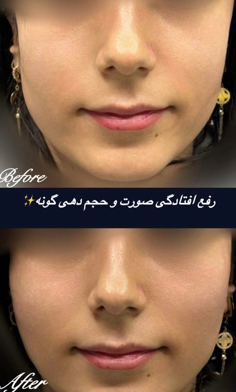 کلاژن مزوتراپی مزونیدلینگ|خدمات آرایشگری و زیبایی|مشهد, کوثر|دیوار