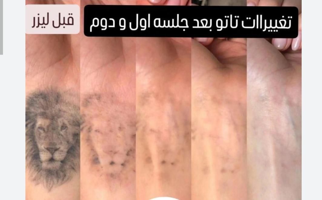 رفع تاتوروشن‌سازی زیربغل کربن تراپی مطب دکترموسوی|خدمات آرایشگری و زیبایی|تهران, فردوس|دیوار