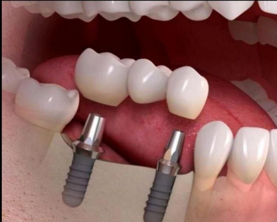 خدمات ایمپلنت دیجیتال|خدمات آرایشگری و زیبایی|شیراز, معالی‌آباد|دیوار