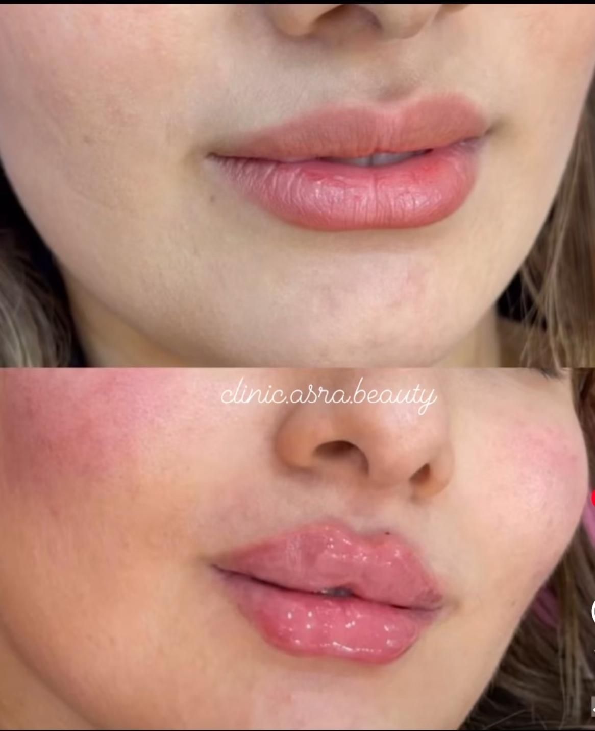 تزریق ژل لب بوتاکس زاویه سازی گونه فول فیس هایفو۲۴|خدمات آرایشگری و زیبایی|مشهد, احمدآباد|دیوار