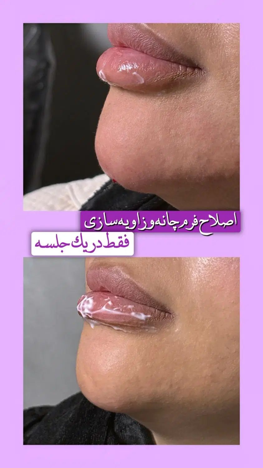 لیزر موهای زائد با دستگاه الکس و تیتانیوم|خدمات آرایشگری و زیبایی|قم, صفائیه|دیوار