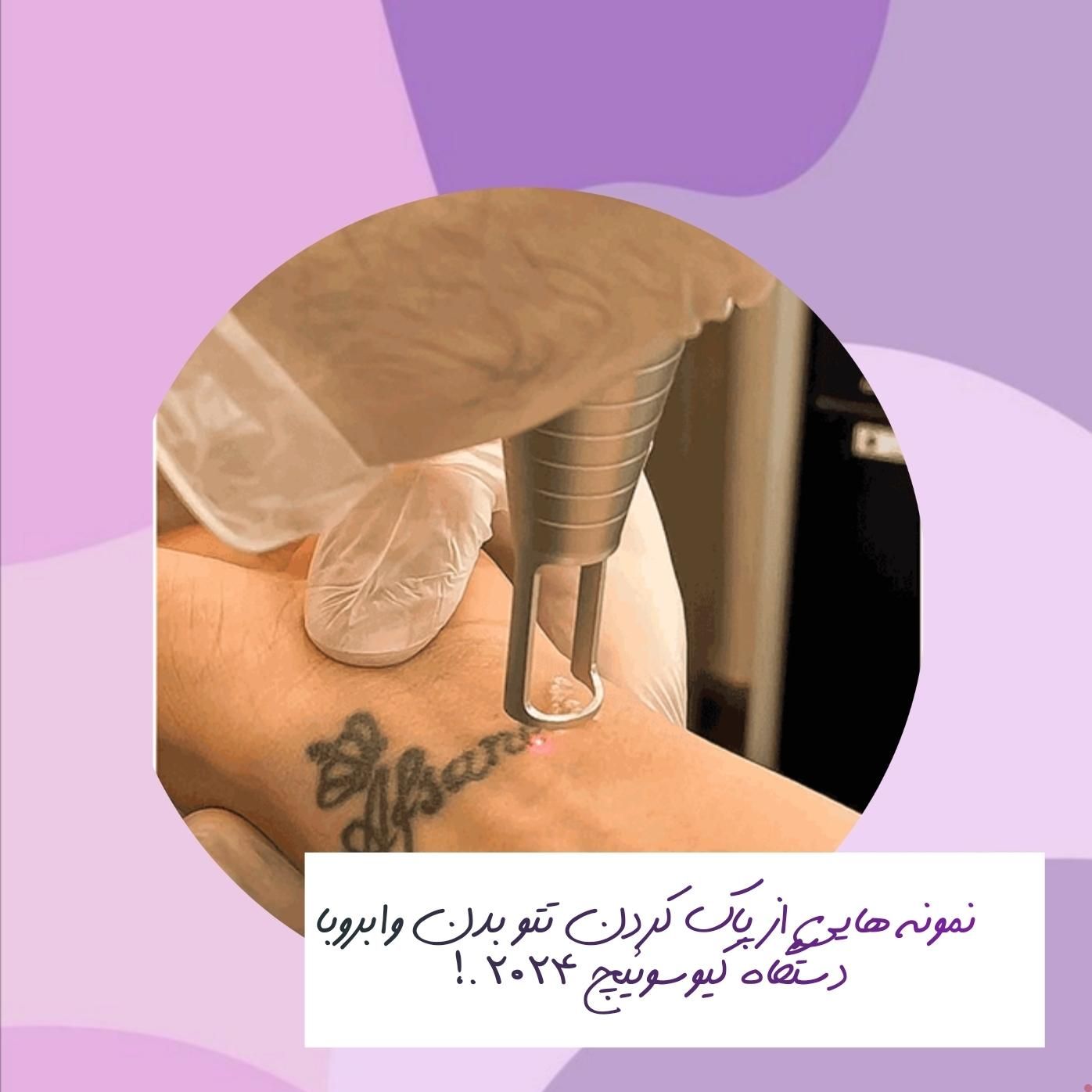 پاک کردن  وریموتاتو بدن و ابرو با لیزر کیوسوئیچ|خدمات آرایشگری و زیبایی|اصفهان, نقش جهان|دیوار