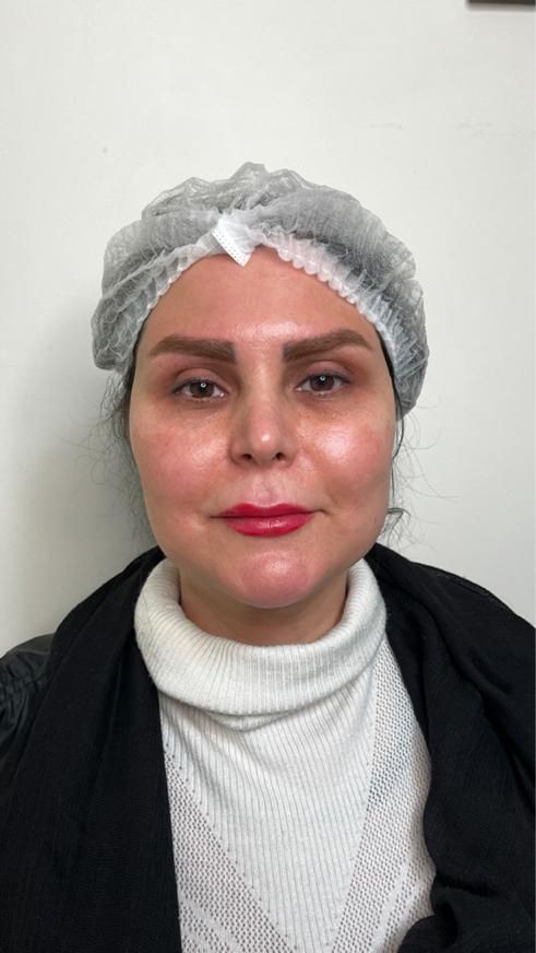 تزریق چربی صورت دست با سن بیکینی در کلینیک تخصصی|خدمات آرایشگری و زیبایی|تهران, صادقیه|دیوار