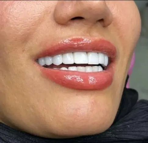 دندانپزشکی/لمینت/روکش|خدمات آرایشگری و زیبایی|تهران, فلسطین (میدان انقلاب)|دیوار