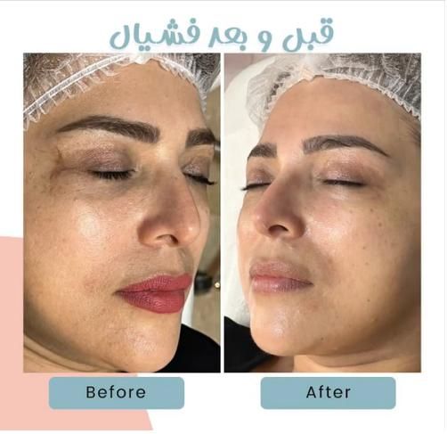 فشیال پوست وپلاژن تراپی درکلینیک با دستگاه|خدمات آرایشگری و زیبایی|کرج, کوی زنبق|دیوار