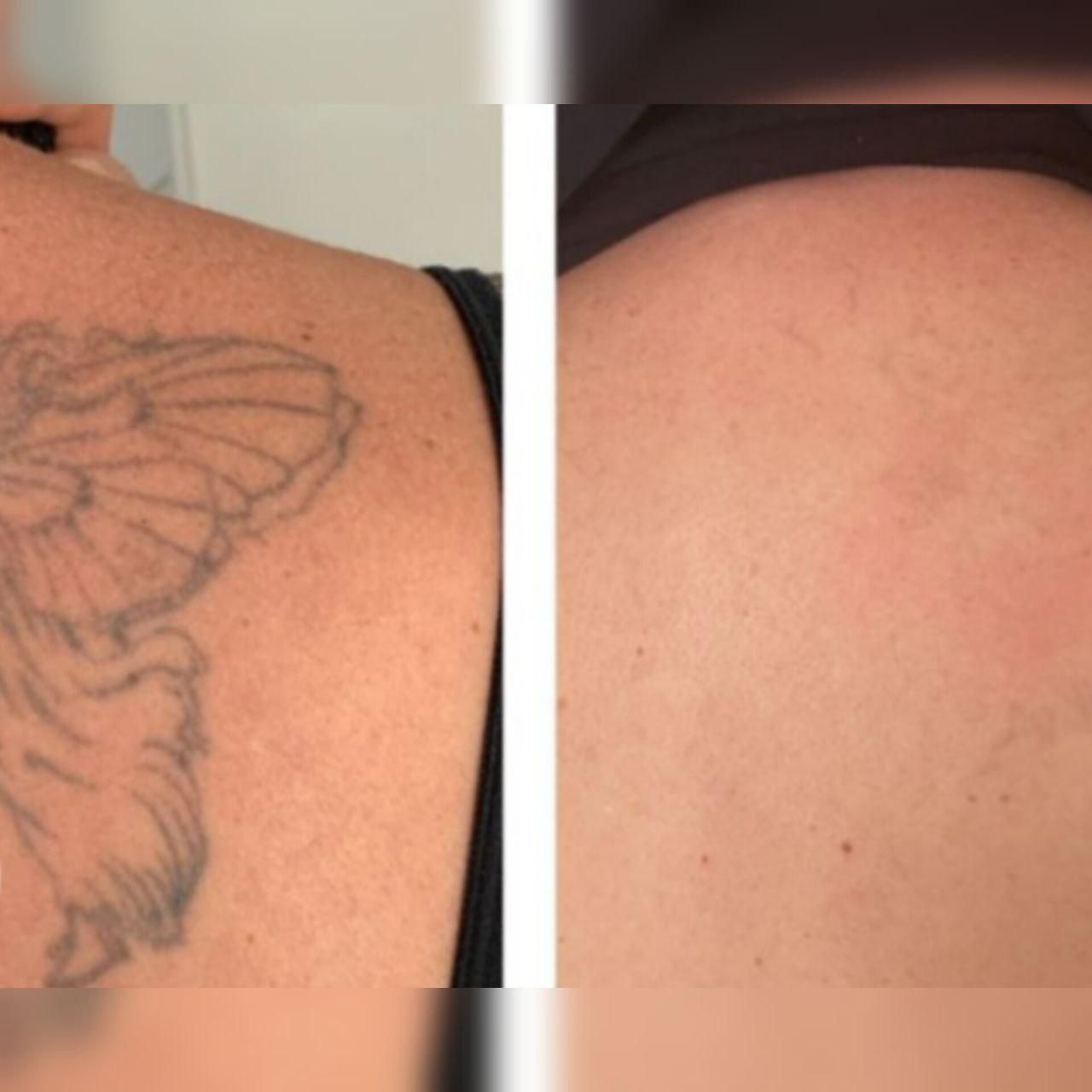 پاک کردن تتو .لیزر.پاککردن خالکوبی .ریموو تتو.prp|خدمات آرایشگری و زیبایی|اصفهان, خلجا|دیوار