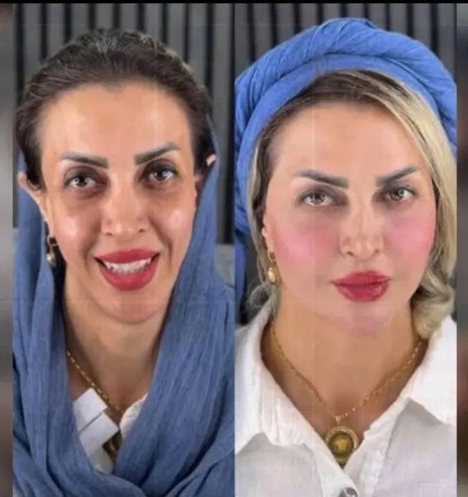تزریق ژل لب و گونه و چانه.. (جشنواره)درمطب فقط499ت|خدمات آرایشگری و زیبایی|اصفهان, باغ زیار|دیوار