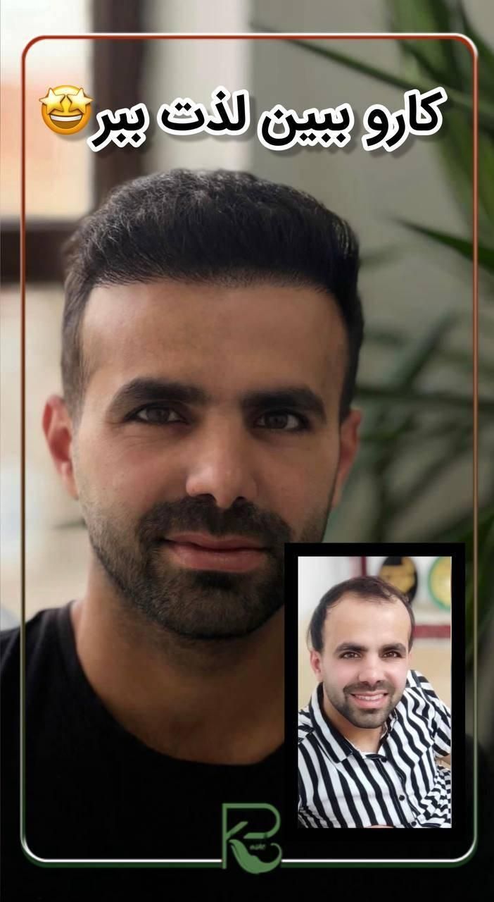 کاشت مو ابرو و ریش تارکوب|خدمات آرایشگری و زیبایی|نظرآباد, |دیوار