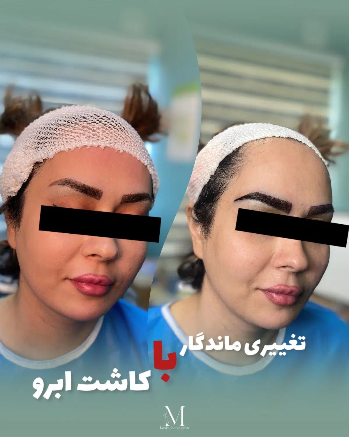 کاشت ابرو فقط با۶ میلیون|خدمات آرایشگری و زیبایی|رشت, گلسار|دیوار