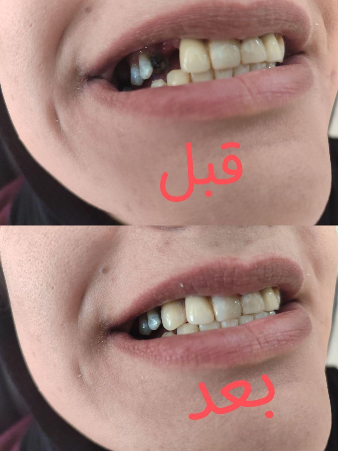 دندان مصنوعی از دم قسط|خدمات آرایشگری و زیبایی|اصفهان, شیخ طوسی|دیوار