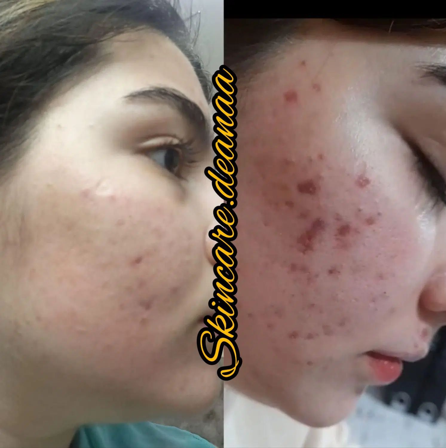 شیدلب.رفع تیرگی.فشیال تخصصی.آموزش.پیراپزشک هستم|خدمات آرایشگری و زیبایی|زاهدان, |دیوار
