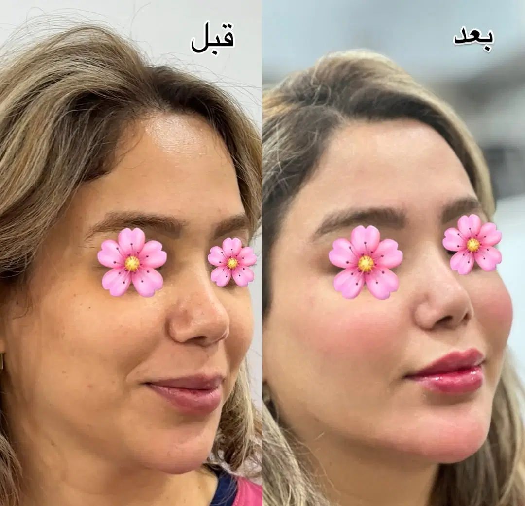 تخفیف ژل بوتاکس مزو آنزیم فیلر غبغب پی ارپی|خدمات آرایشگری و زیبایی|اصفهان, وحید|دیوار