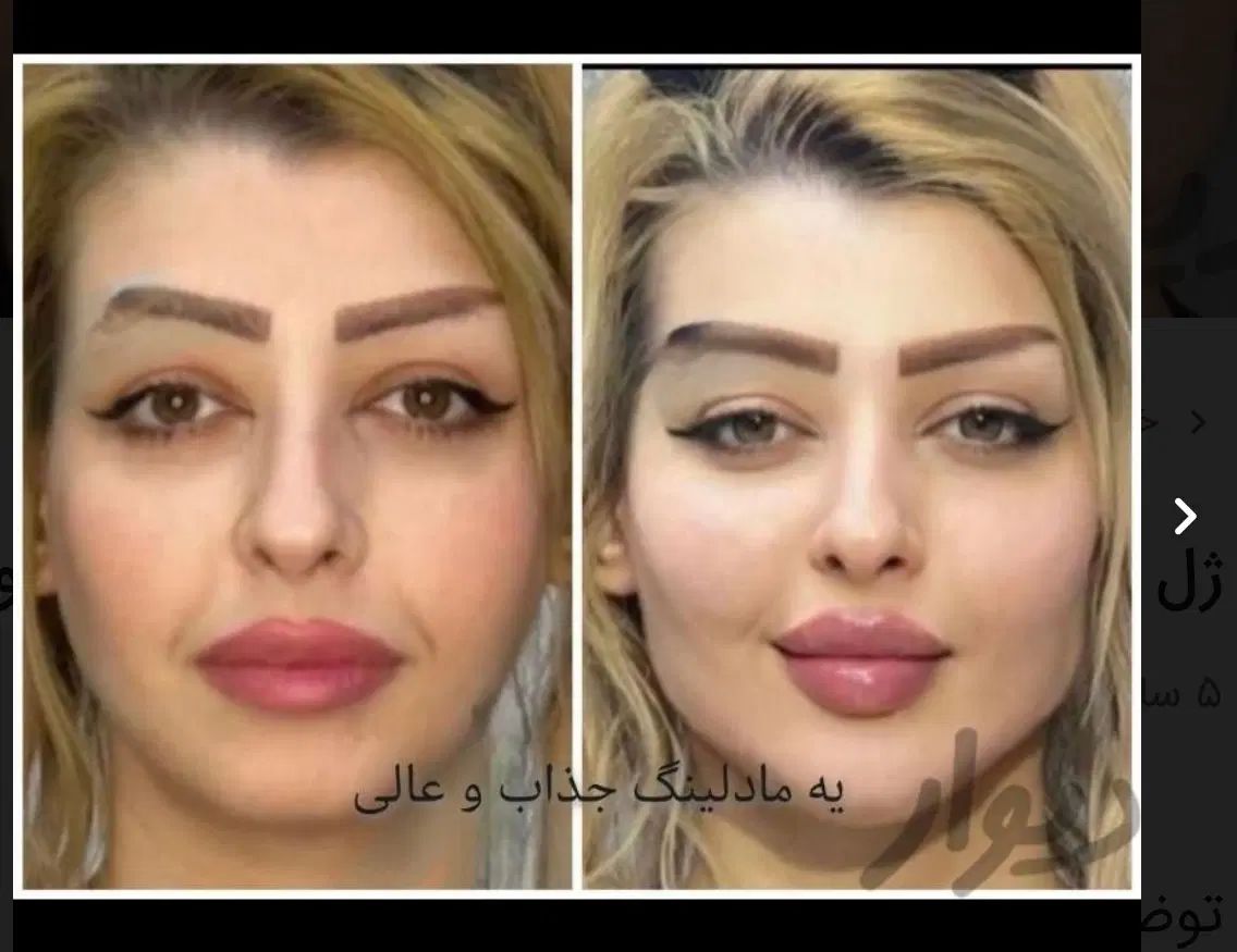هایفوتراپی/هایفو ساکشن  شکم‌ ابدو /بلفاروپلاستی|خدمات آرایشگری و زیبایی|مشهد, وکیل‌آباد|دیوار