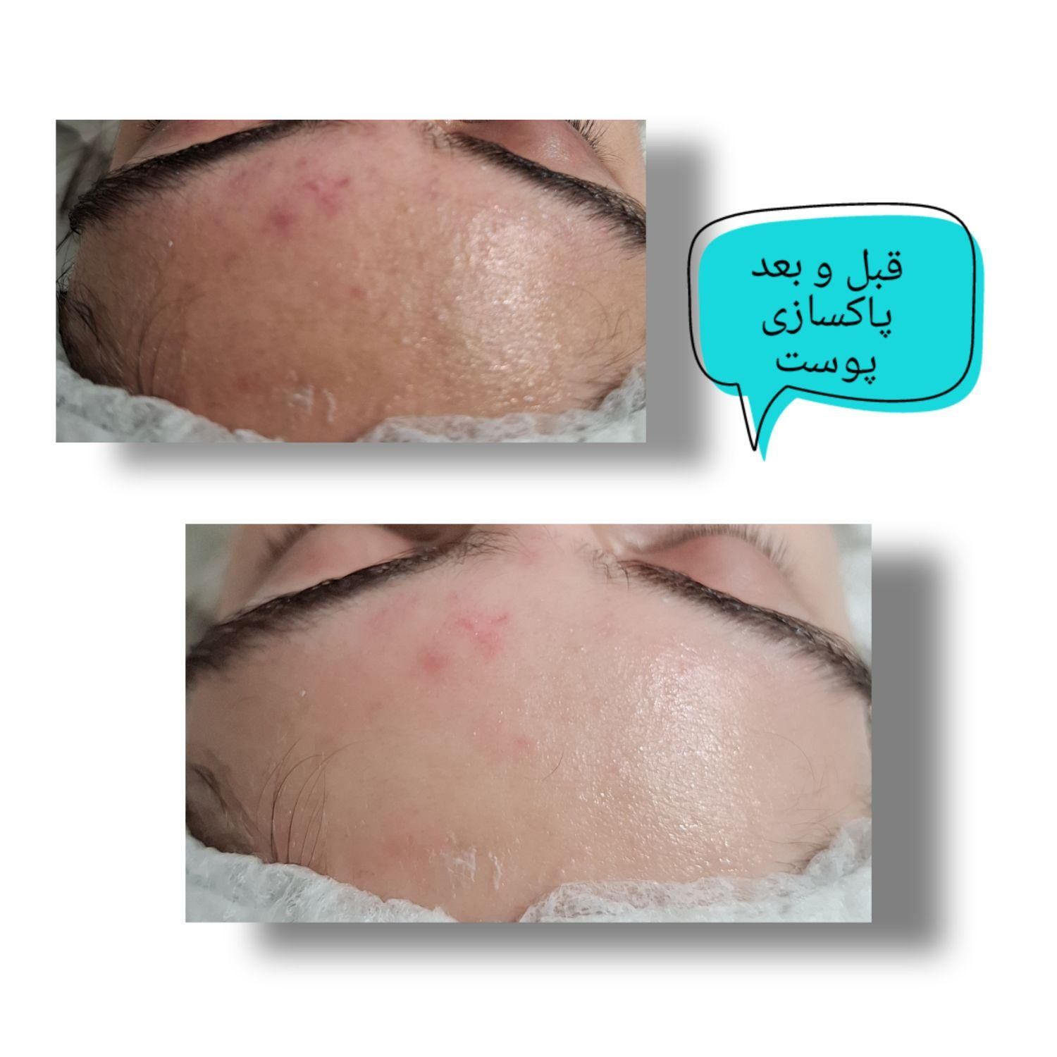 اموزش وخدمات پاکسازی پوست آقاخانوم(تخفیف)ویال مو|خدمات آرایشگری و زیبایی|گرگان, |دیوار