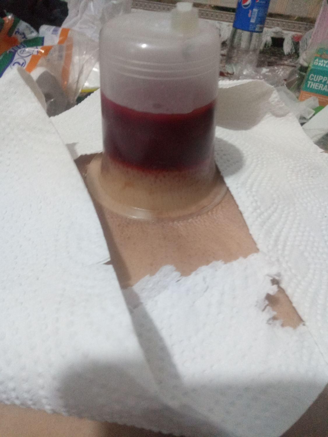 آموزش و انجام تزریقات حجامت زالودرمانی|خدمات آرایشگری و زیبایی|دورود, |دیوار