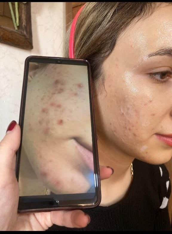 ٪۳۰ تخفیف فشیال و پاکسازی پوست و صورت در کلینیک|خدمات آرایشگری و زیبایی|قم, پردیسان|دیوار
