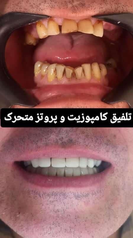 دندان مصنوعی تحویل ۵ساعته(شهر محلات)کامپوزیت دندان|خدمات آرایشگری و زیبایی|قم, سالاریه|دیوار