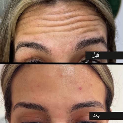تزریق مزوژل روشن‌کننده جوانساز وبوتاکس|خدمات آرایشگری و زیبایی|آبادان, |دیوار