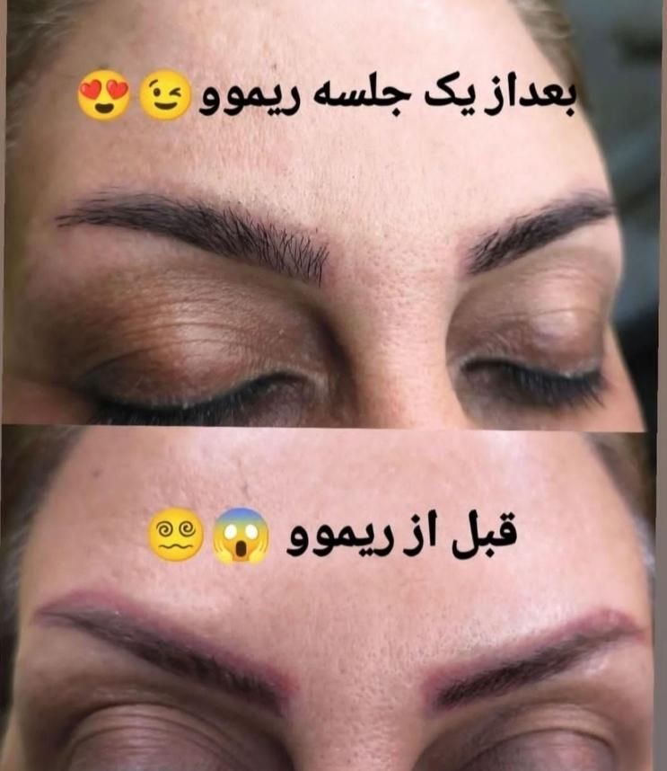 ریموو تتو با اشانتیون  در کلینیک زیبایی|خدمات آرایشگری و زیبایی|تهران, تهرانپارس غربی|دیوار