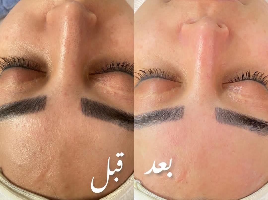 فیشیال و پاکسازی تخصصی پوست|خدمات آرایشگری و زیبایی|قم, قلعه کامکار|دیوار