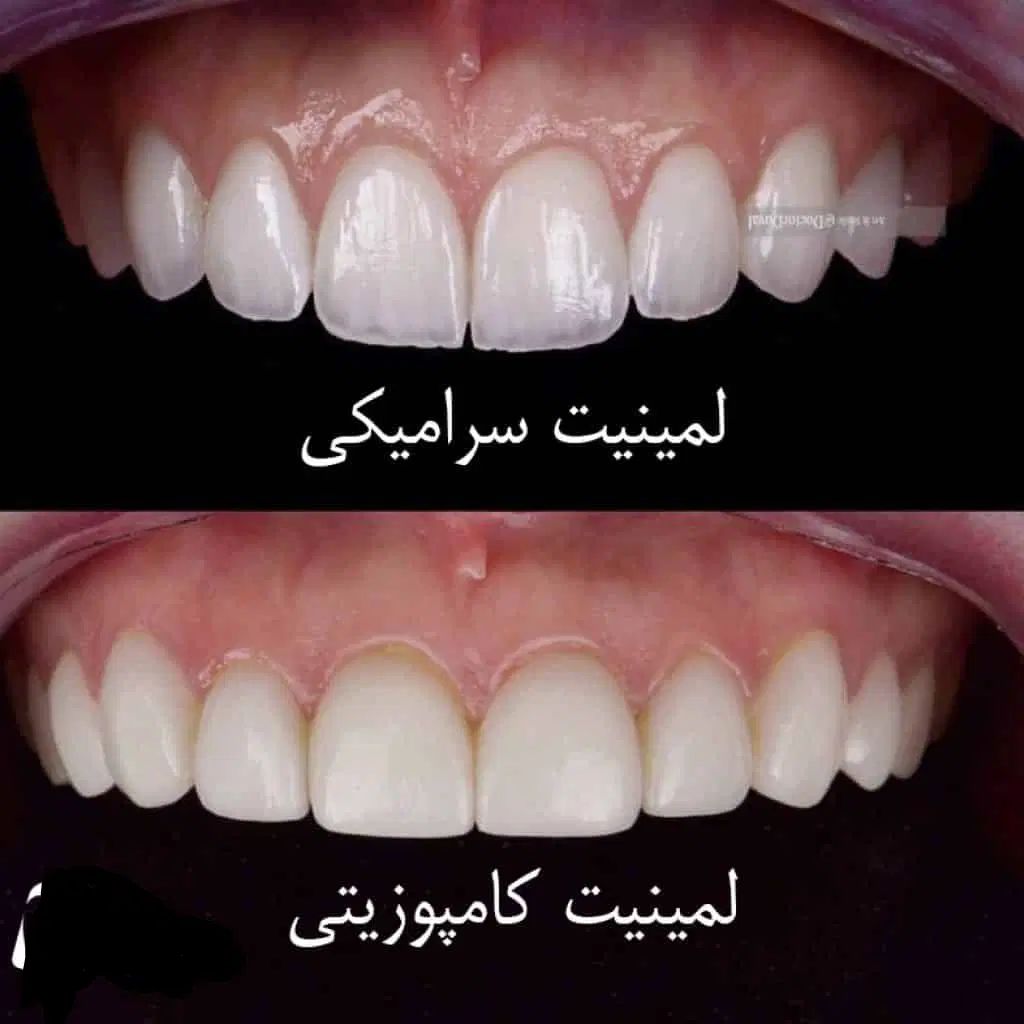 لمینیت و کامپوزیت|خدمات آرایشگری و زیبایی|تهران, پاسداران|دیوار