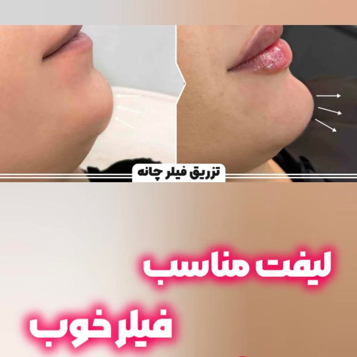جشنواره تزریق ژل و بوتاکس|خدمات آرایشگری و زیبایی|اصفهان, دانشگاه اصفهان|دیوار