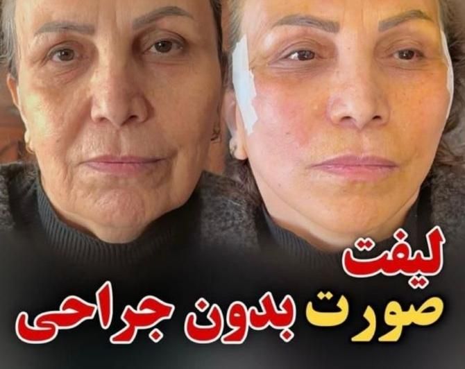 اندولیفت.لیپوفیس.ساکشن غبغب با اولترا زد|خدمات آرایشگری و زیبایی|مشهد, سناباد|دیوار