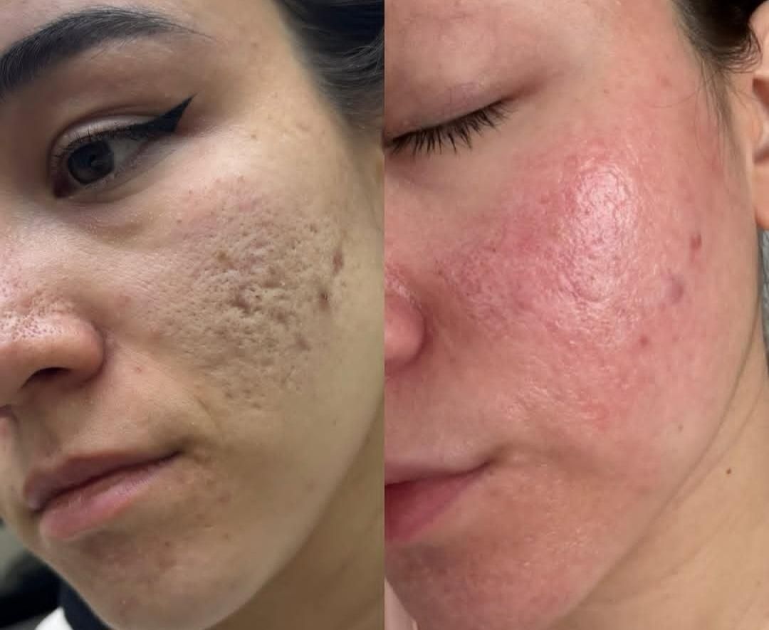 پاکسازی و فیشال /درمان جوش و لک و منافذباز|خدمات آرایشگری و زیبایی|کرمانشاه, |دیوار