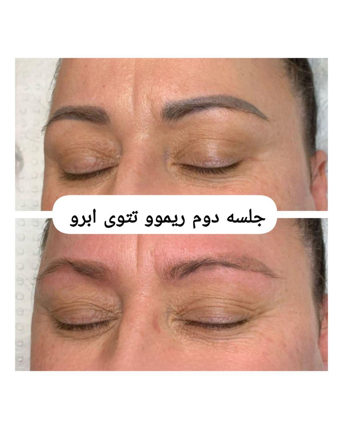هایفو جوانساز، کیوسوئیچ، ریموو تتو،لیزر موهای زائد|خدمات آرایشگری و زیبایی|آبادان, |دیوار