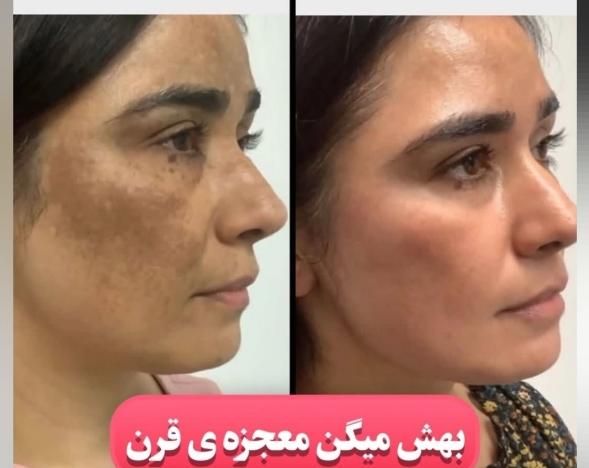 لیزر موهای زائدروشن کننده ورفع لک رفع منافذبوتاکس|خدمات آرایشگری و زیبایی|رشت, بوسار|دیوار