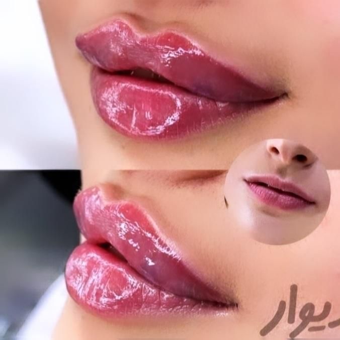 نیازمند مدل بوتاکس و ژل.اموزش ژل و بوتاکس|خدمات آرایشگری و زیبایی|صدرا-فارس, فاز ۱|دیوار