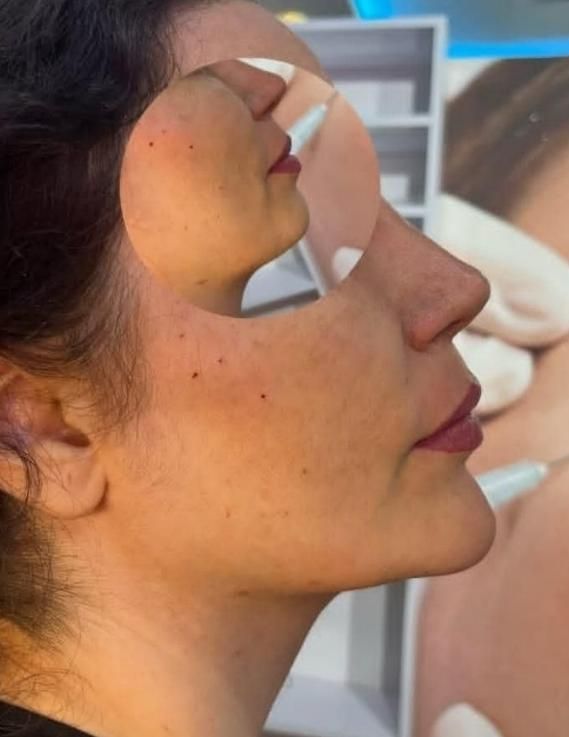 اف ژل لب وآف بوتاکس درمطب پزشک|خدمات آرایشگری و زیبایی|مشهد, احمدآباد|دیوار