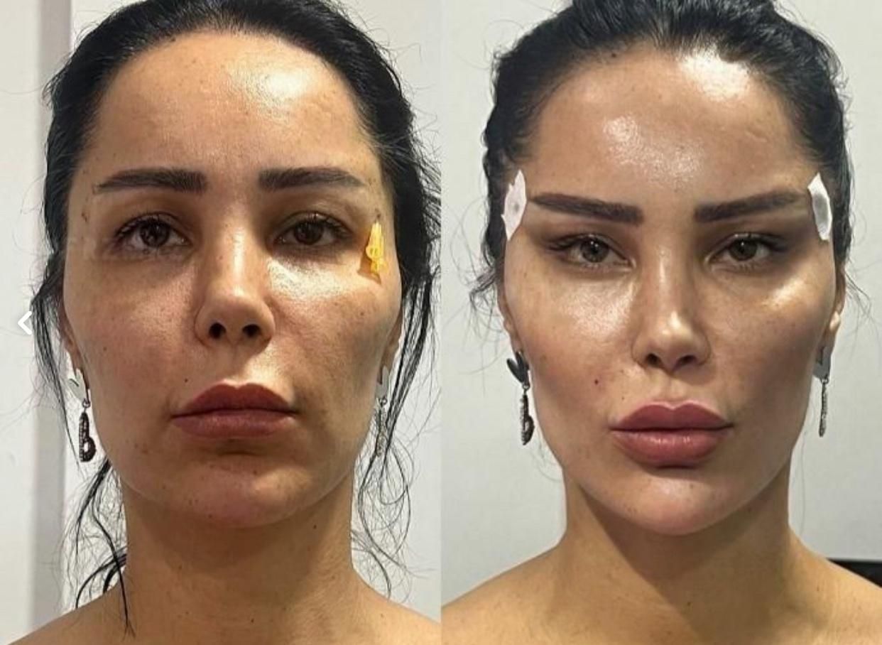 جشنوار بلفاروپلاستی-غبغب-بوکال فت-سانترال لب|خدمات آرایشگری و زیبایی|تهران, پاسداران|دیوار