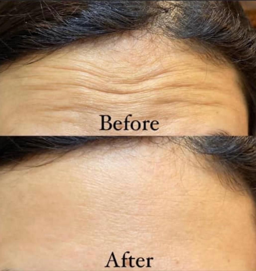 اف ویژه ژل بوتاکس بندرعباس|خدمات آرایشگری و زیبایی|بندرعباس, |دیوار