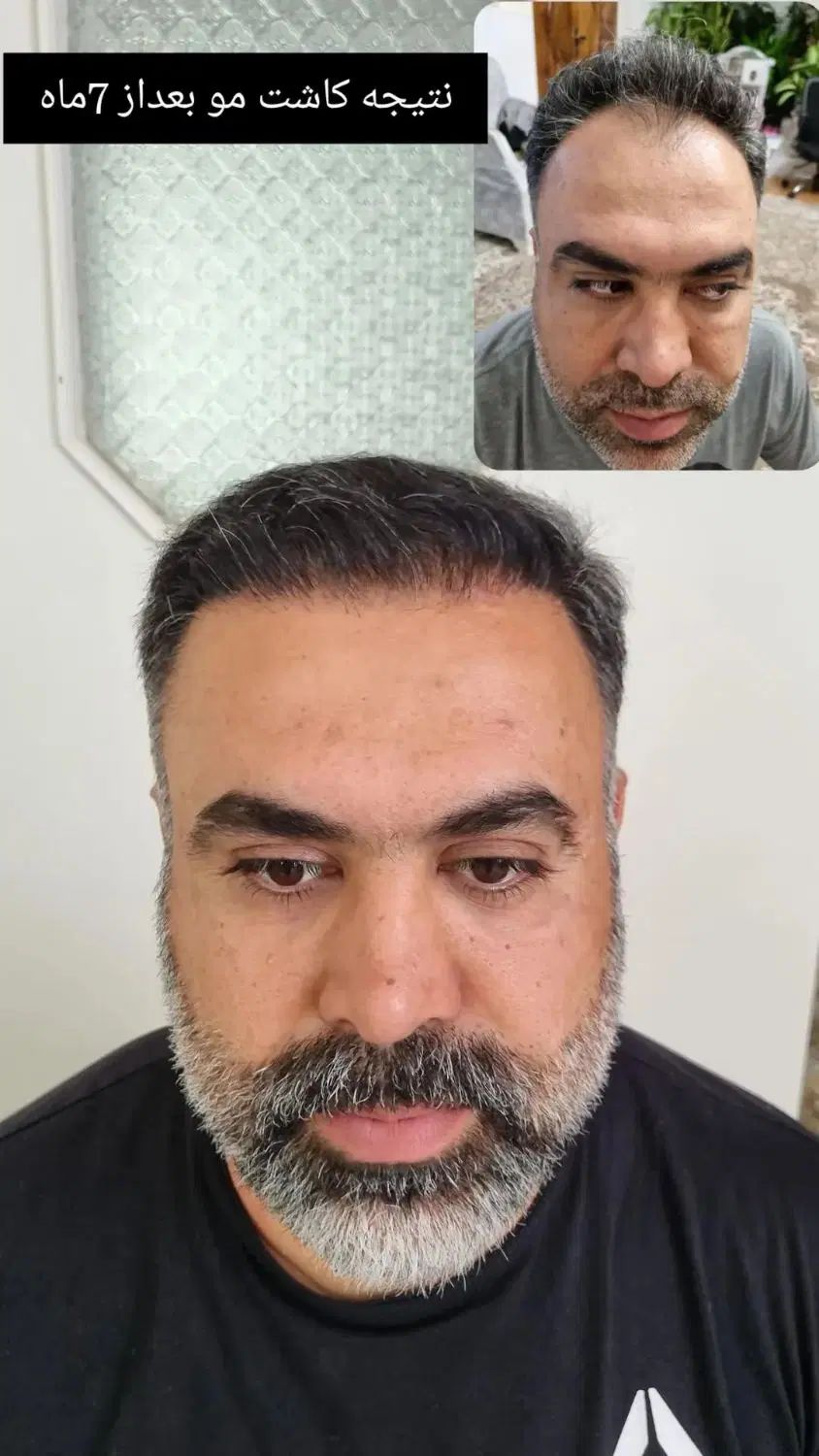 کاشت مو ابرو لیزر ژل بوتاکس مزو واکسن زگیل تناسلی|خدمات آرایشگری و زیبایی|اندیشه, اندیشه فاز ۱|دیوار