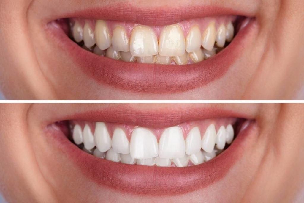 سفید کردن دندان|خدمات آرایشگری و زیبایی|رشت, دیلمان|دیوار