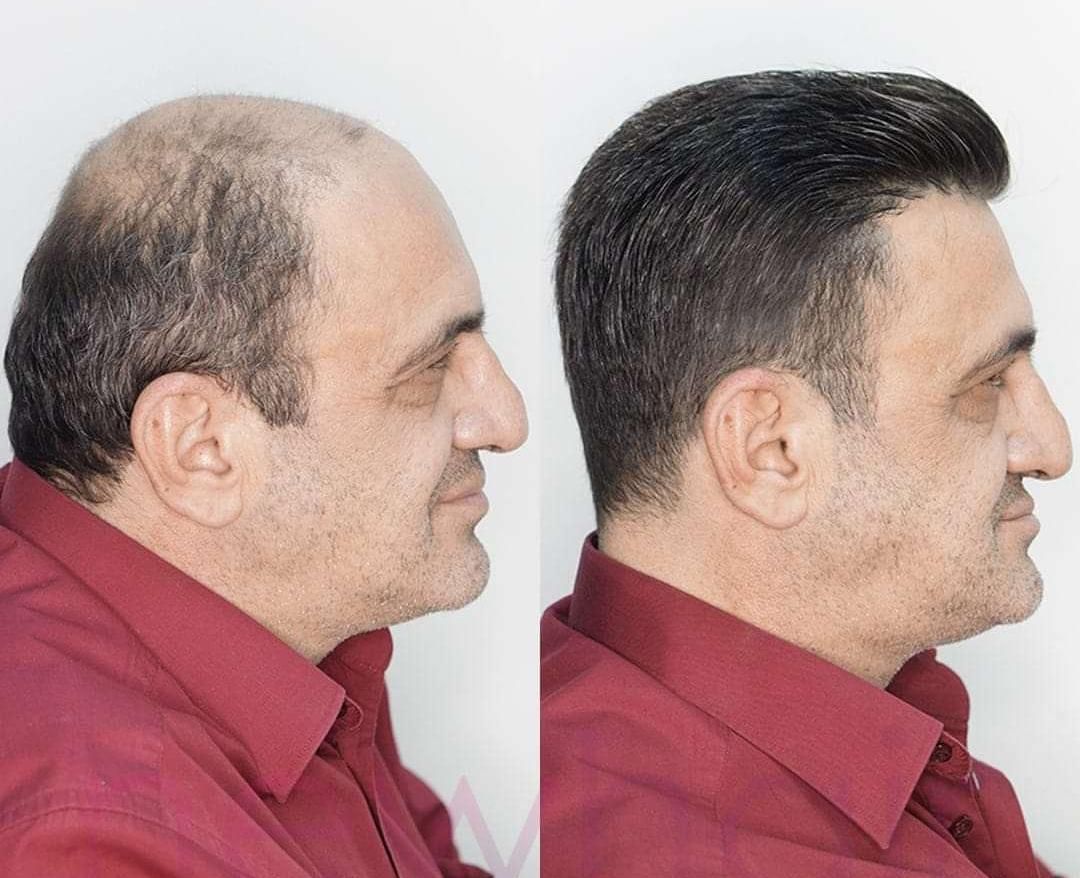 فروش و نصب پروتز موی طبیعی و چسب پروتز ریموور|خدمات آرایشگری و زیبایی|اردبیل, |دیوار