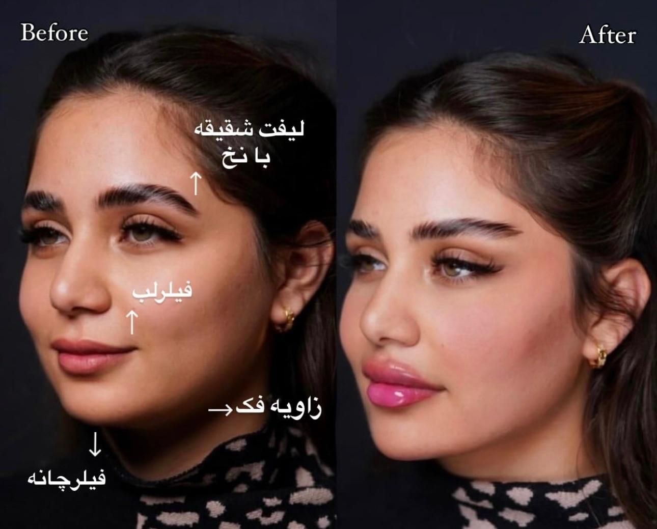 جوانسازی و حجم دهی صورت با کمترین هزینه|خدمات آرایشگری و زیبایی|مشهد, هفت تیر (حافظ)|دیوار
