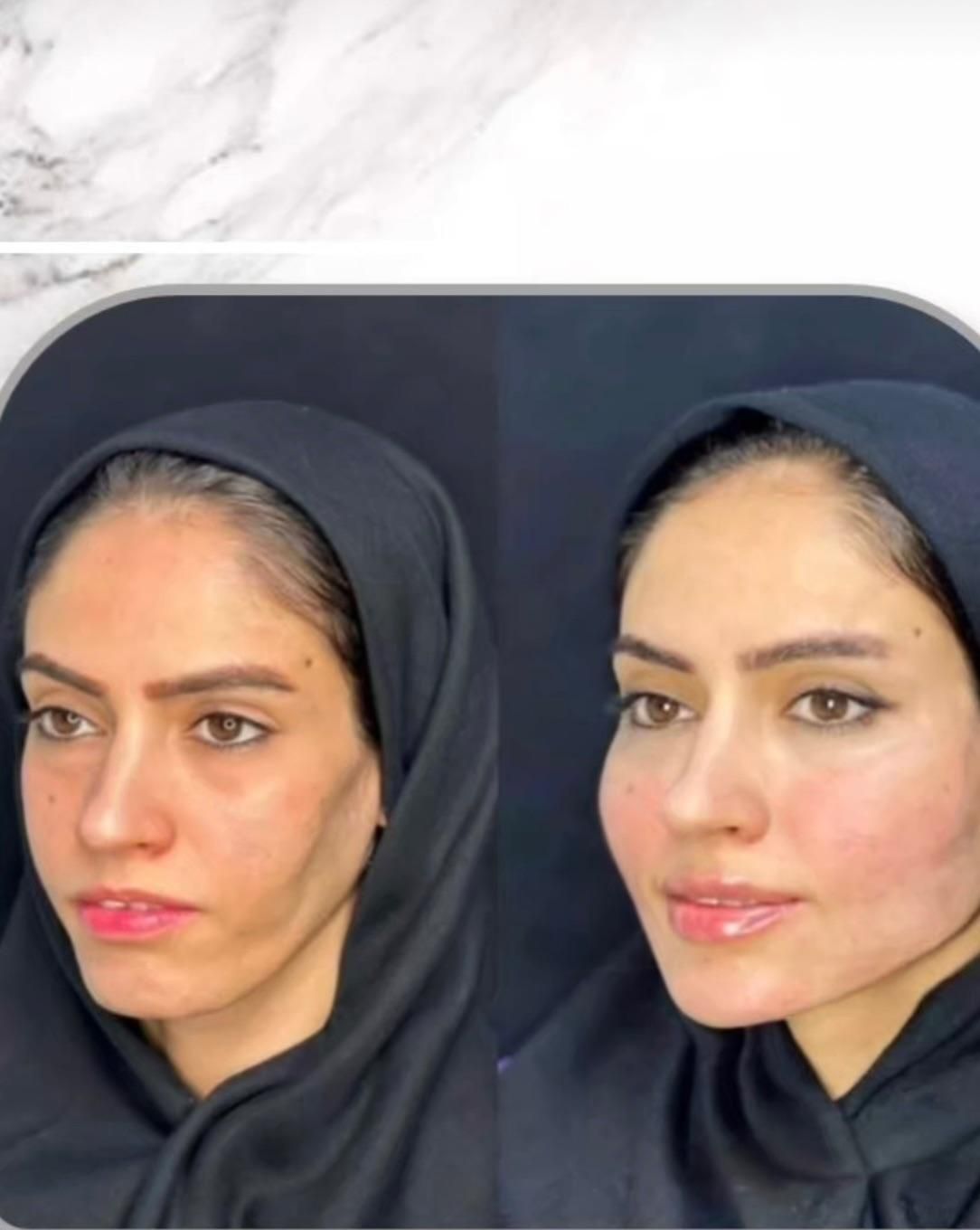 لیفت BAU فیس لیفت صورت اصلاح افتادگی لاغری صورت|خدمات آرایشگری و زیبایی|مشهد, هفت تیر (حافظ)|دیوار