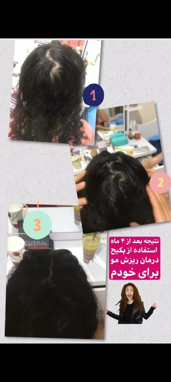 افزایش رشد موی سر و ریش صورت|آرایشی، بهداشتی، درمانی|اصفهان, مصلی|دیوار