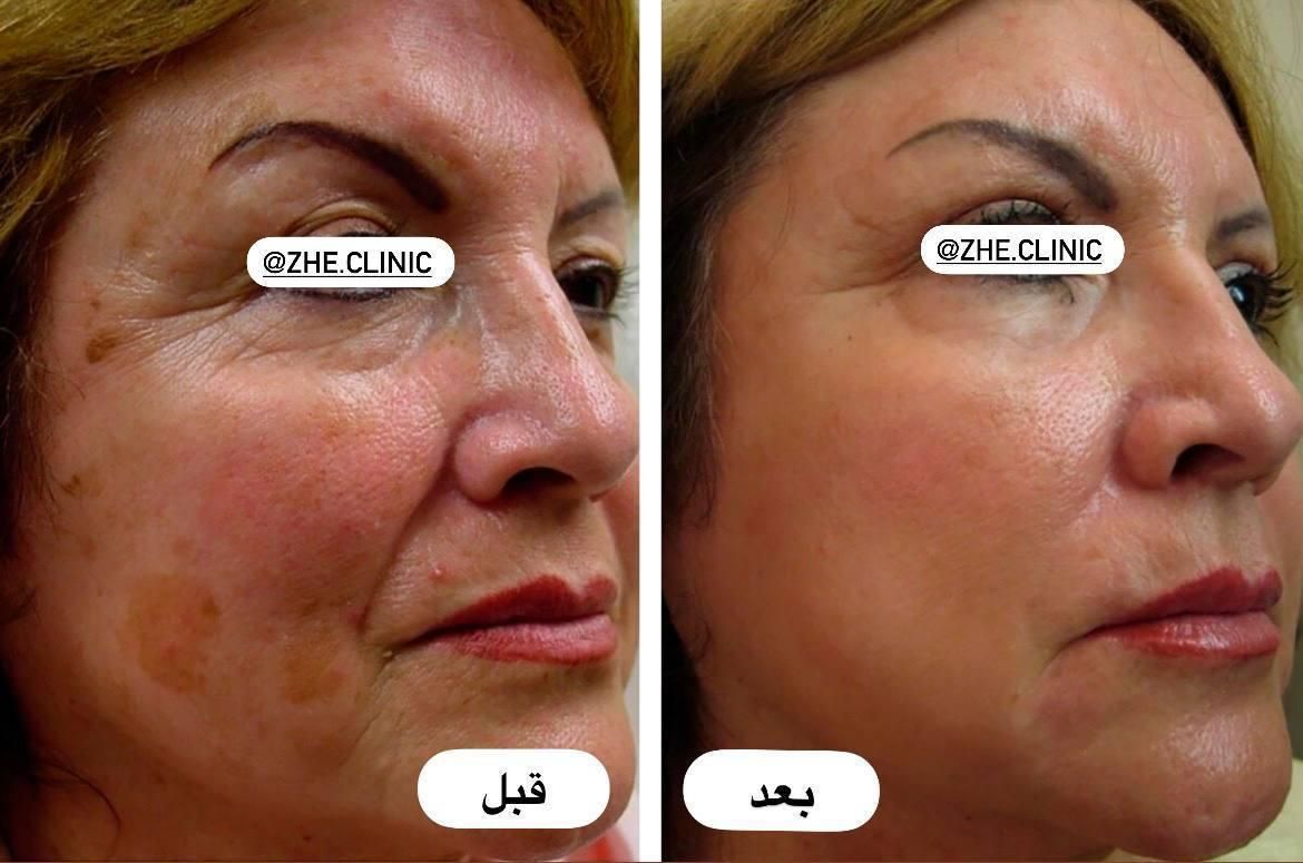 پی آر پی (جشنواره)فقط 690|خدمات آرایشگری و زیبایی|مشهد, طلاب|دیوار