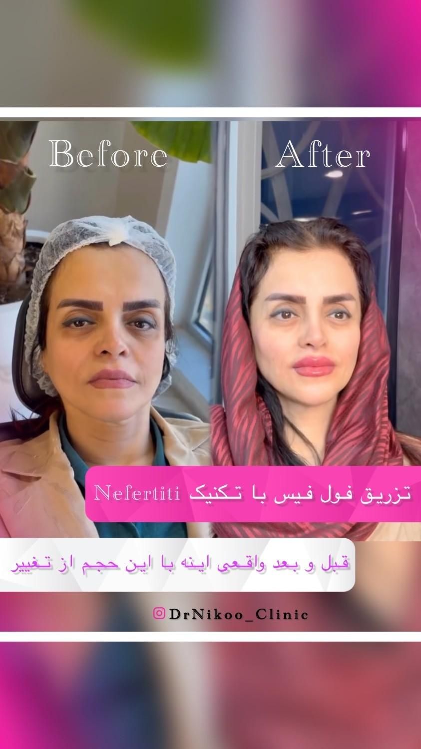 تخفیف طلایی بوتاکس و مزوتراپی|خدمات آرایشگری و زیبایی|تهران, جماران (نیاوران)|دیوار
