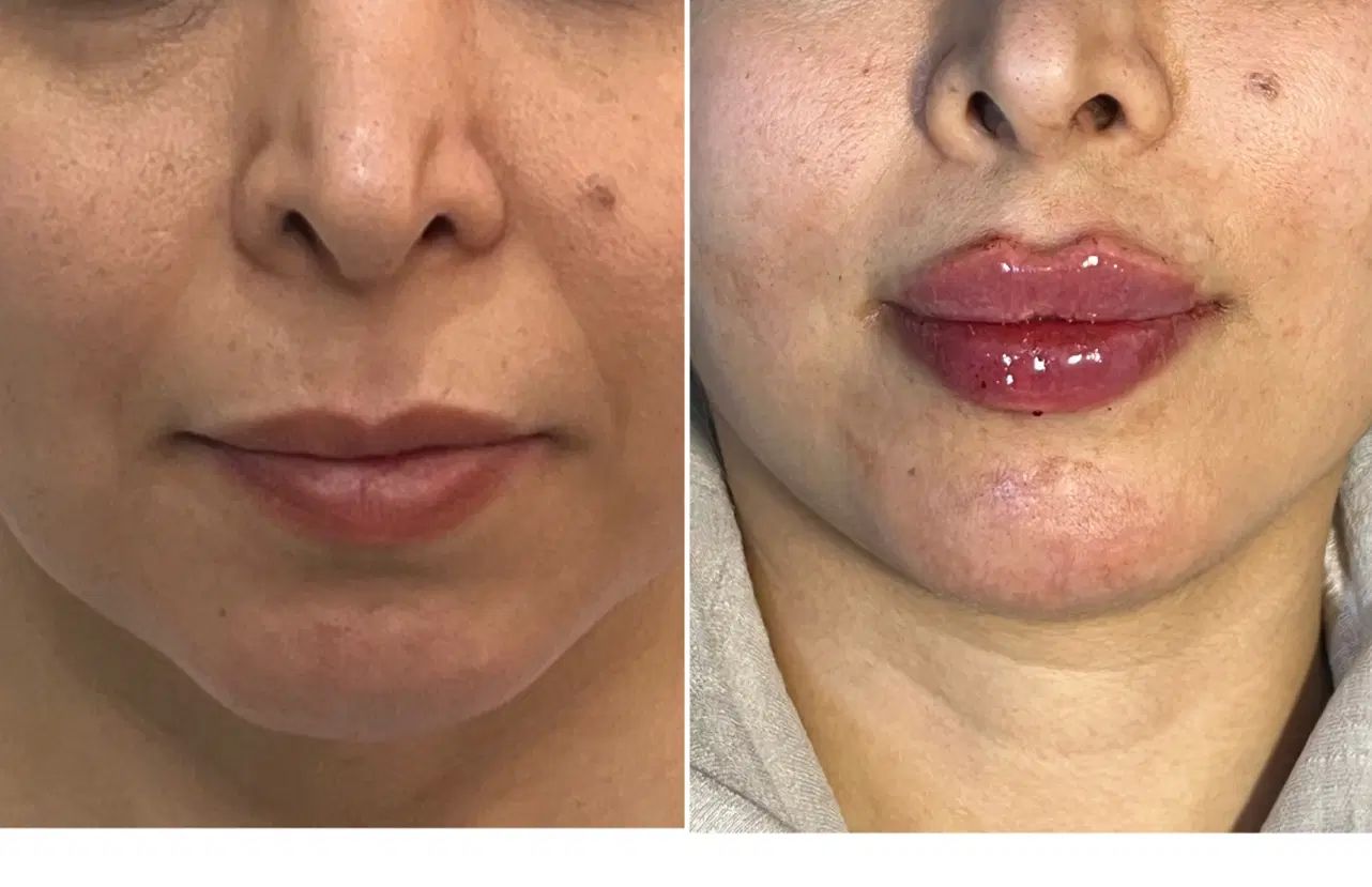 تزریق ژل و بوتاکس و مزوتراپی/ژل لب M تکنیک|خدمات آرایشگری و زیبایی|مشهد, نیروی هوایی|دیوار