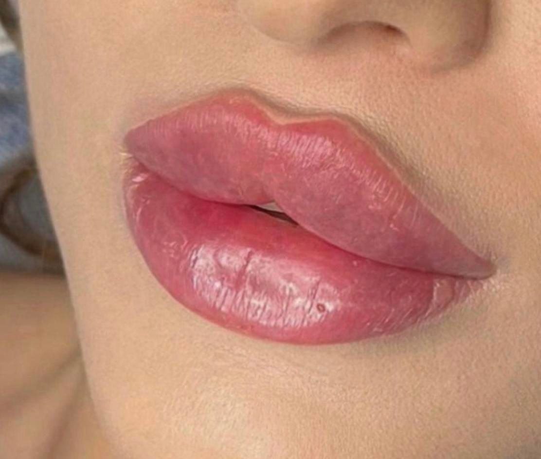 لیفت/هایفو تزریق ژل نورامیس رئوفیل/لیزر توسطپزشک|خدمات آرایشگری و زیبایی|تهران, ستارخان|دیوار