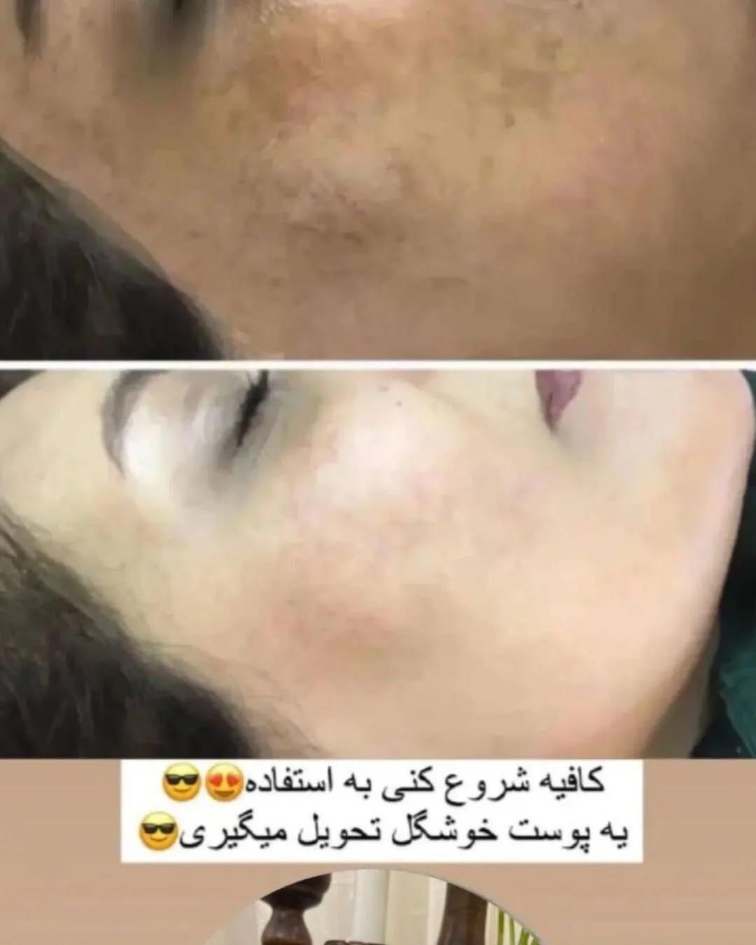 درمان لک ومشکلات پوستی|آرایشی، بهداشتی، درمانی|رشت, کوی جام جم|دیوار