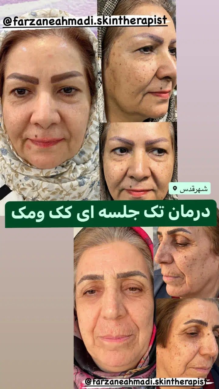 درمان کک ومک/درمان لک/درمان جوش/ردبخیه/اسکار|خدمات آرایشگری و زیبایی|قدس, شهر‌قدس|دیوار