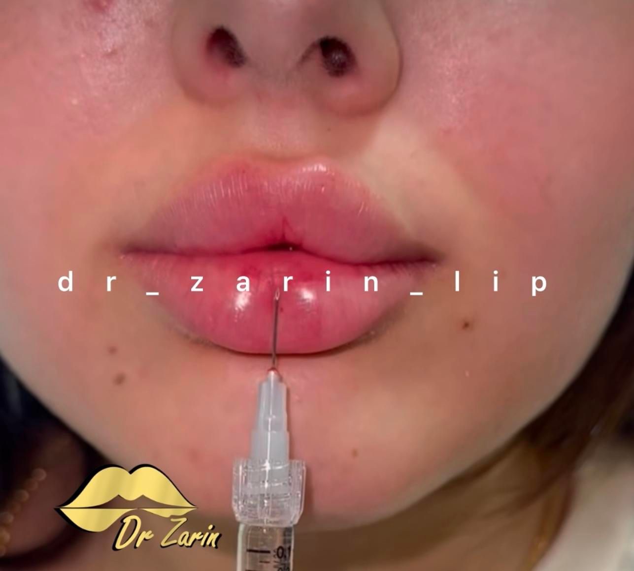 تزریق تخصصی فیلر زیر چشم بینی ژل لب روسی لیفت گونه|خدمات آرایشگری و زیبایی|تهران, پونک|دیوار